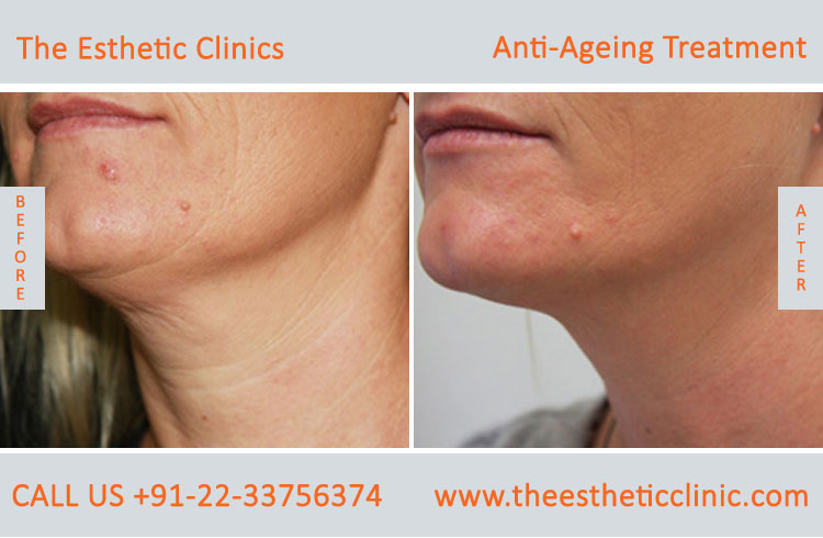 Anti Aging Treatment for Face Wrinkles before after photos in mumbai india (1 (4)